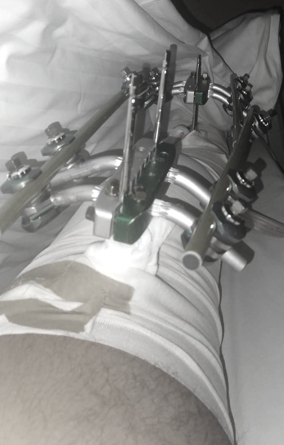 Bein mit äußerem Fixateur nach der Not-OP im Krankenhausbett