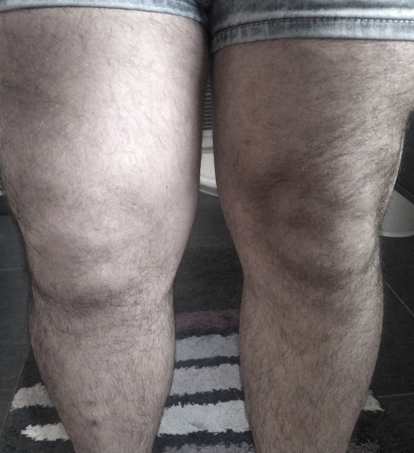 Vergleich der beiden Beine, eines stark geschwollen und deformiert